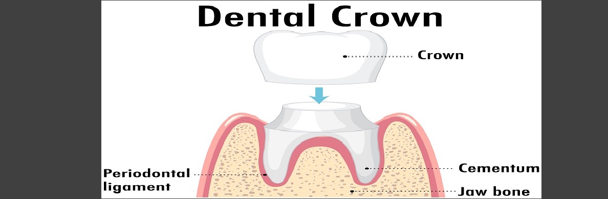 What are the disadvantages of dental crowns?