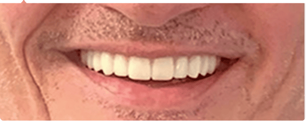 After dental implant treatment for Patient B