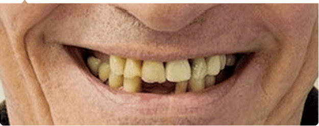 Before dental implant treatment for Patient B